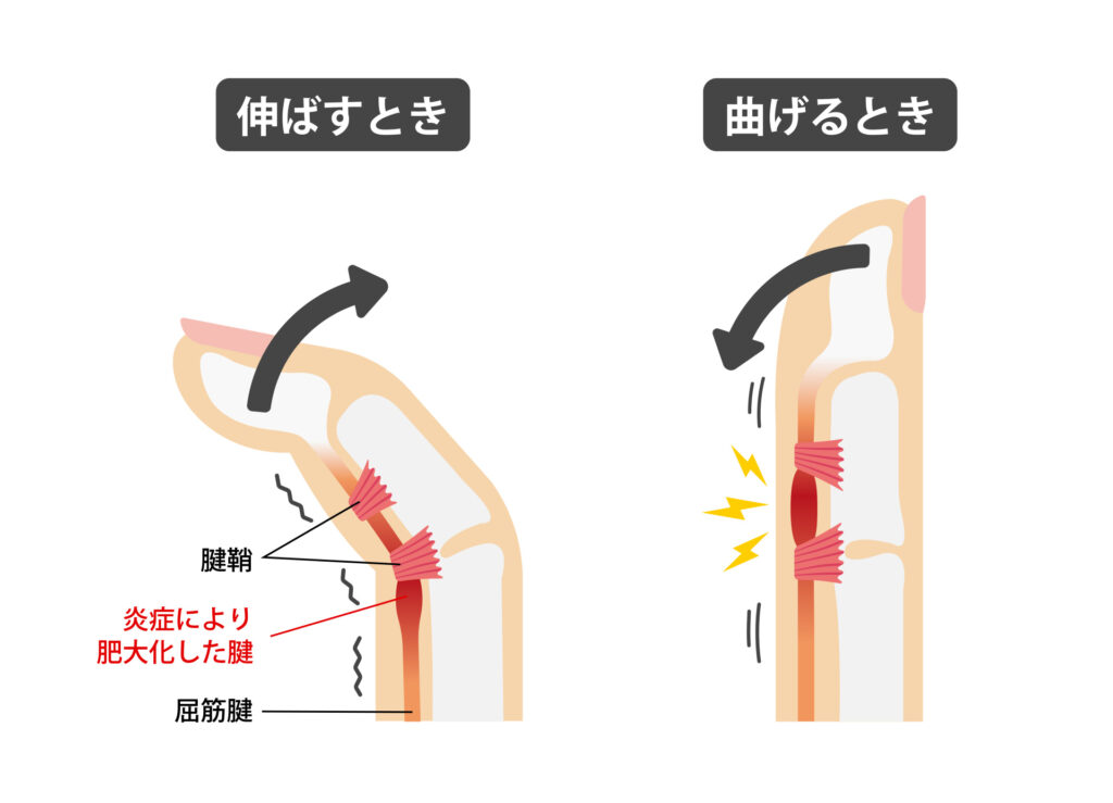 手指の状態評価