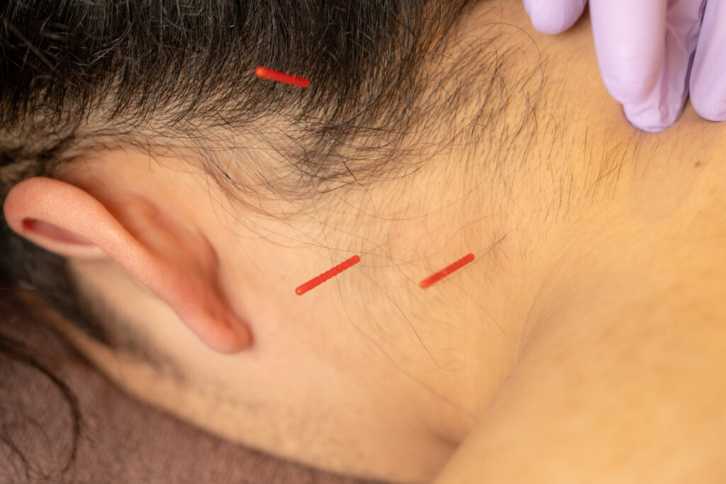 頭痛の専門施術イメージ